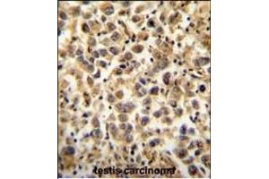 CCDC19 Antibody (N-term) (ABIN654396 and ABIN2844138) immunohistochemistry analysis in formalin fixed and paraffin embedded human testis carcinoma followed by peroxidase conjugation of the secondary antibody and DAB staining.
