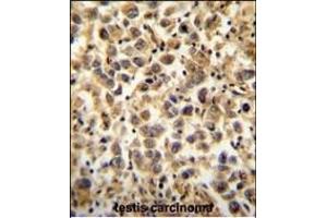 CCDC19 Antibody (N-term) (ABIN654396 and ABIN2844138) immunohistochemistry analysis in formalin fixed and paraffin embedded human testis carcinoma followed by peroxidase conjugation of the secondary antibody and DAB staining. (CCDC19 anticorps  (N-Term))