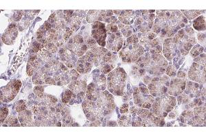 ABIN6273226 at 1/100 staining Human pancreas cancer tissue by IHC-P. (DIO1 anticorps  (C-Term))
