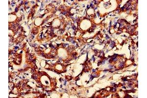 Immunohistochemistry of paraffin-embedded human gastric cancer using ABIN7160449 at dilution of 1:100 (FAM168B anticorps  (AA 43-100))
