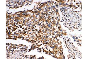 Anti-SMAD5 antibody, IHC(P) IHC(P): Human Lung Cancer Tissue