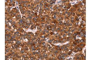 The image on the left is immunohistochemistry of paraffin-embedded Human liver cancer tissue using ABIN7190739(GAGE12I Antibody) at dilution 1/20, on the right is treated with synthetic peptide. (G Antigen 12I anticorps)