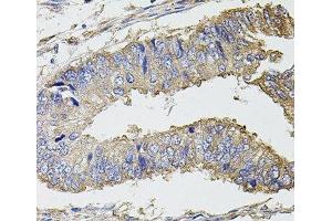 Immunohistochemistry of paraffin-embedded Human colon carcinoma using UBE2S Polyclonal Antibody at dilution of 1:100 (40x lens).