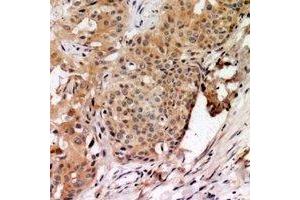 Immunohistochemical analysis of TAGAP staining in human breast cancer formalin fixed paraffin embedded tissue section. (TAGAP anticorps)