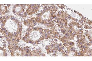 ABIN6273962 at 1/100 staining Human liver cancer tissue by IHC-P. (OR6C75 anticorps)
