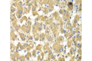 Immunohistochemistry of paraffin-embedded Human liver damage using MAP4K3 Polyclonal Antibody at dilution of 1:100 (40x lens). (MAP4K3 anticorps)