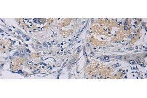 Immunohistochemistry of paraffin-embedded Human esophagus cancer tissue using KLF1 Polyclonal Antibody at dilution of 1:35(x200)