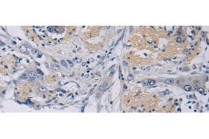 Immunohistochemistry of paraffin-embedded Human esophagus cancer tissue using KLF1 Polyclonal Antibody at dilution of 1:35(x200)