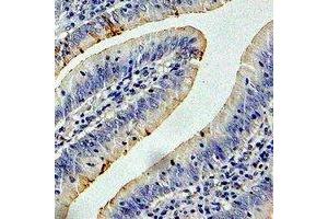 Immunohistochemical analysis of CCT3 staining in human colon cancer formalin fixed paraffin embedded tissue section. (CCT3 anticorps)
