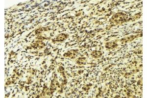 ABIN6277988 at 1/100 staining Human breast cancer tissue by IHC-P.