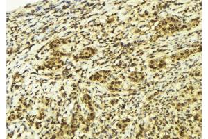 ABIN6277988 at 1/100 staining Human breast cancer tissue by IHC-P. (CTNNBL1 anticorps  (N-Term))