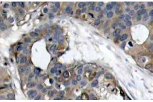 Immunohistochemistry (IHC) analyzes of HSP27 antibody in paraffin-embedded human breast carcinoma tissue. (HSP27 anticorps)