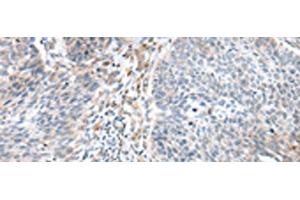 Immunohistochemistry of paraffin-embedded Human lung cancer tissue using WFDC5 Polyclonal Antibody at dilution of 1:60(x200) (WFDC5 anticorps)