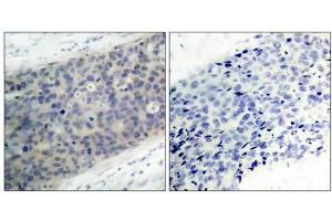 Immunohistochemical analysis of paraffin- embedded human breast carcinoma tissue using LIMK2 (phospho-Thr505) antibody (E011127). (LIMK2 anticorps  (pThr505))