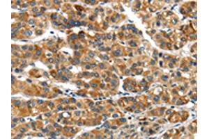 The image on the left is immunohistochemistry of paraffin-embedded Human liver cancer tissue using ABIN7192974(UBAP2 Antibody) at dilution 1/20, on the right is treated with synthetic peptide. (UBAP2 anticorps)