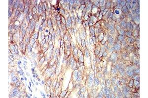 Immunohistochemical analysis of paraffin-embedded ovarian cancer tissues using CD166 mouse mAb with DAB staining.
