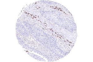 Squamous cell carcinoma containing many IgA positive plasma cells in its stroma (Recombinant Lapin anti-Humain IgA Anticorps)