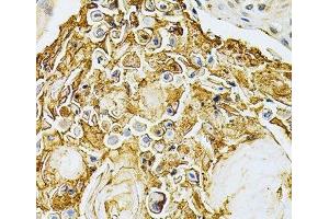 Immunohistochemistry of paraffin-embedded Human esophageal cancer using ADRBK1 Polyclonal Antibody at dilution of 1:200 (40x lens). (GRK2 anticorps)