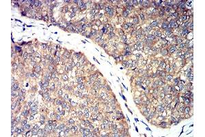Immunohistochemical analysis of paraffin-embedded ROP1 tissues using bladder cancer mouse mAb with DAB staining. (ROP1 (AA 42-183) anticorps)