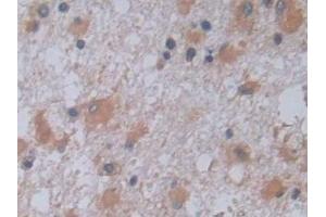 Detection of JAG2 in Human Glioma Tissue using Polyclonal Antibody to Jagged 2 Protein (JAG2) (JAG2 anticorps  (AA 714-981))