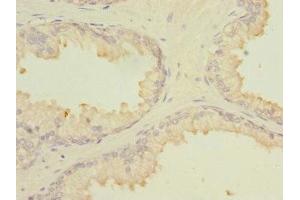 Immunohistochemistry of paraffin-embedded human prostate cancer using ABIN7159008 at dilution of 1:100 (MARCKSL1 anticorps  (AA 1-195))