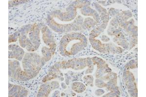 IHC-P Image Immunohistochemical analysis of paraffin-embedded human gastric cancer, using SRPR, antibody at 1:100 dilution.