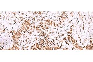 Immunohistochemistry of paraffin-embedded Human ovarian cancer tissue using ISY1-RAB43 Polyclonal Antibody at dilution of 1:55(x200) (ISY1-RAB43 Readthrough (ISY1-RAB43) anticorps)