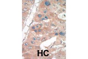 Formalin-fixed and paraffin-embedded human hepatocellular carcinoma tissue reacted with CDKN1A polyclonal antibody  , which was peroxidase-conjugated to the secondary antibody, followed by DAB staining. (p21 anticorps  (C-Term))