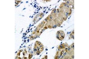 Immunohistochemical analysis of CHMP2B staining in human gastric cancer formalin fixed paraffin embedded tissue section. (CHMP2B anticorps)