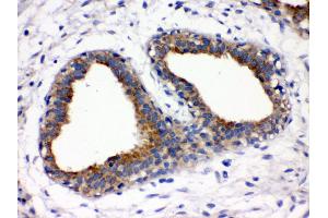Anti- FUT1 Picoband antibody, IHC(P) IHC(P): Human Mammary Cancer Tissue