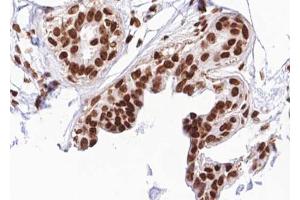 ABIN6267691 at 1/100 staining human breast carcinoma tissue sections by IHC-P.