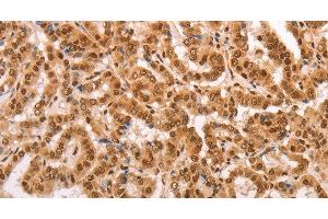 Immunohistochemistry of paraffin-embedded Human thyroid cancer tissue using HEXIM1 Polyclonal Antibody at dilution 1:65 (HEXIM1 anticorps)