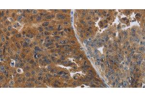 Immunohistochemistry of paraffin-embedded Human ovarian cancer tissue using PDCD2 Polyclonal Antibody at dilution 1:50 (PDCD2 anticorps)