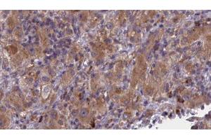 ABIN6277011 at 1/100 staining Human liver cancer tissue by IHC-P. (BMPR1B anticorps  (N-Term))
