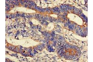 Immunohistochemistry of paraffin-embedded human colon cancer using ABIN7165956 at dilution of 1:100 (PPM1K anticorps  (AA 30-372))