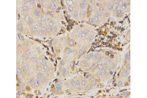 Immunohistochemistry of paraffin-embedded Human liver cancer using KLK5 Polyclonal Antibody at dilution of 1:200 (40x lens). (Kallikrein 5 anticorps)