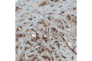 Immunohistochemical staining (Formalin-fixed paraffin-embedded sections) of human breast cancer with WWTR1 monoclonal antibody, clone CL0371  shows strong nuclear and moderate cytoplasmic immunoreactivity in tumor cells.