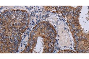 Immunohistochemistry of paraffin-embedded Human colon cancer tissue using NDUFA1 Polyclonal Antibody at dilution 1:30 (NDUFA1 anticorps)