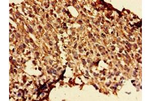 Immunohistochemistry of paraffin-embedded human melanoma using ABIN7154186 at dilution of 1:100 (GLRA1 anticorps  (AA 23-113))