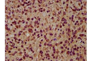 IHC image of ABIN7143995 diluted at 1:200 and staining in paraffin-embedded human glioma performed on a Leica BondTM system. (AIMP1 anticorps  (AA 25-180))