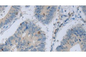 Immunohistochemistry of paraffin-embedded Human colon cancer using MAGEB4 Polyclonal Antibody at dilution of 1:40 (MAGEB4 anticorps)