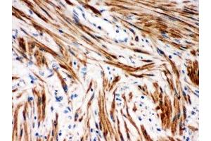 IHC-P: IkB beta antibody testing of human intestinal cancer tissue (NFKBIB anticorps  (AA 56-237))