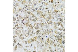 Immunohistochemistry of paraffin-embedded human lung cancer using DMAP1 antibody. (DMAP1 anticorps  (AA 1-305))