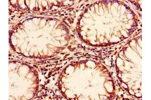 Immunohistochemistry of paraffin-embedded human colon cancer using ABIN7151381 at dilution of 1:100