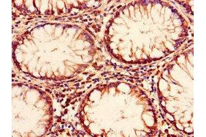 Immunohistochemistry of paraffin-embedded human colon cancer using ABIN7151381 at dilution of 1:100 (ENTPD8 anticorps  (AA 30-434))