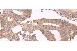 Immunohistochemistry of paraffin-embedded Human colorectal cancer tissue using MGP Polyclonal Antibody at dilution of 1:75(x200)