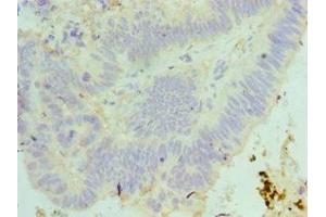 Immunohistochemistry of paraffin-embedded human colon cancer using ABIN7160089 at dilution of 1:100 (MAD2L1 anticorps  (AA 1-205))