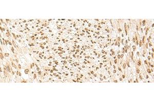 Immunohistochemistry of paraffin-embedded Human liver cancer tissue using POM121 Polyclonal Antibody at dilution of 1:75(x200) (POM121 anticorps)