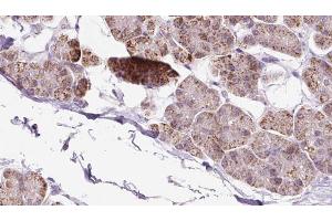 ABIN6273241 at 1/100 staining Human pancreas cancer tissue by IHC-P. (EXOC5 anticorps  (Internal Region))