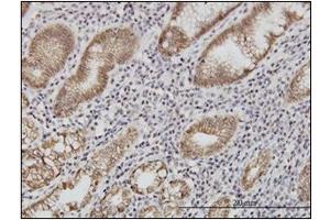 Immunohistochemistry (IHC) image for anti-Cadherin 1, Type 1, E-Cadherin (Epithelial) (CDH1) (AA 381-481) antibody (ABIN614587) (E-cadherin anticorps  (AA 381-481))